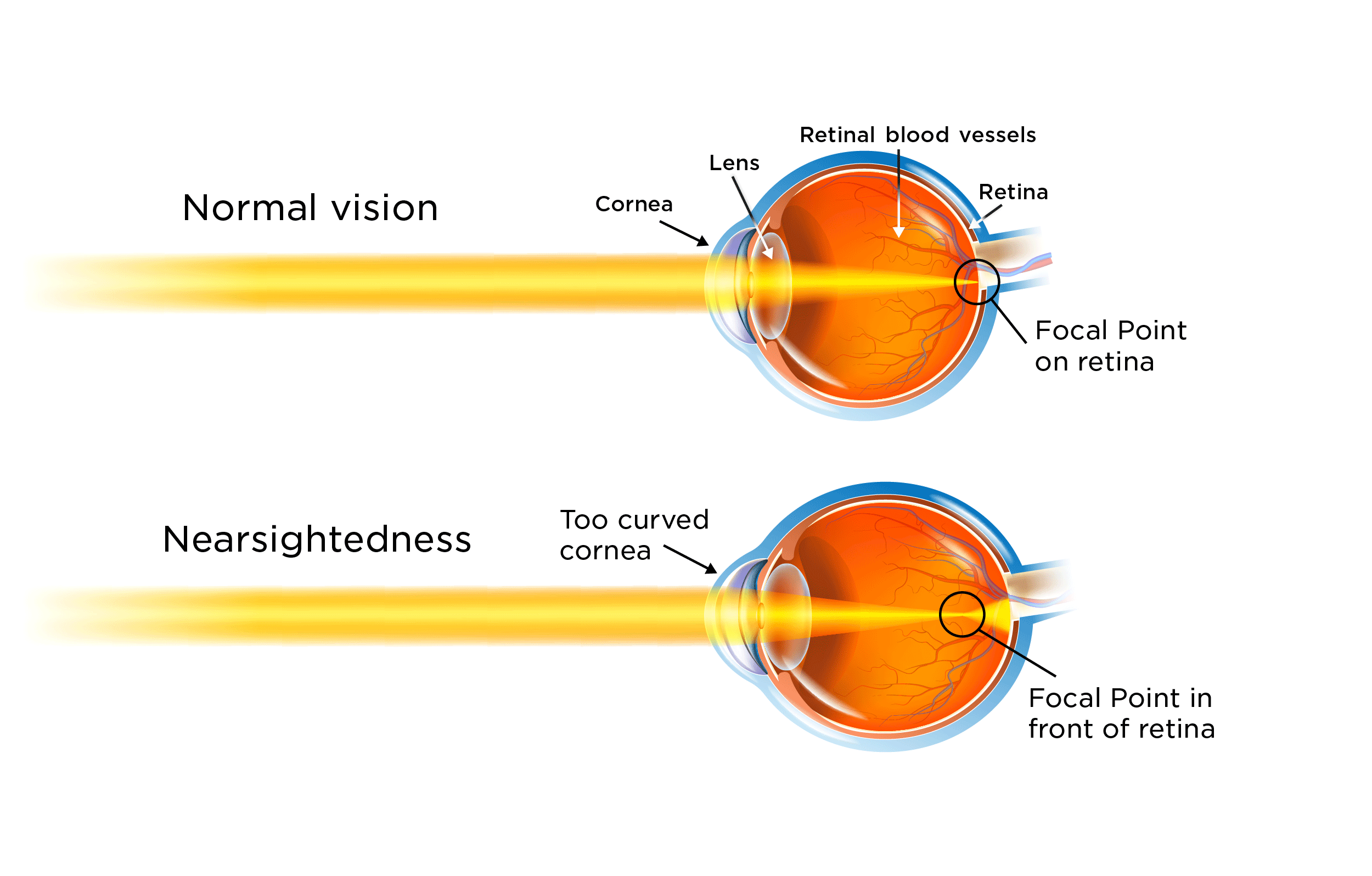 Nearsightedness can be corrected by using eyeglass lenses that are online